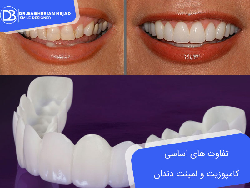 تفاوت های اساسی کامپوزیت و لمینت دندان