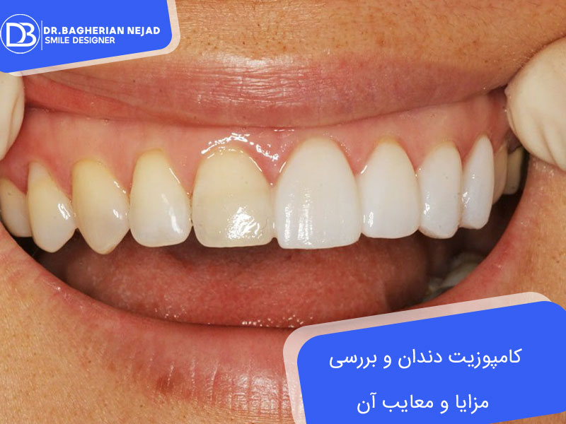 کامپوزیت دندان و بررسی مزایا و معایب آن