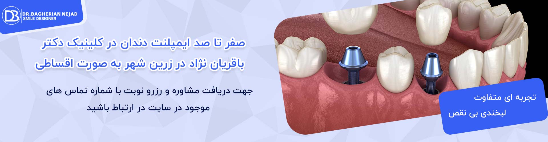 ایمپلنت دندان اقساطی در زرین شهر