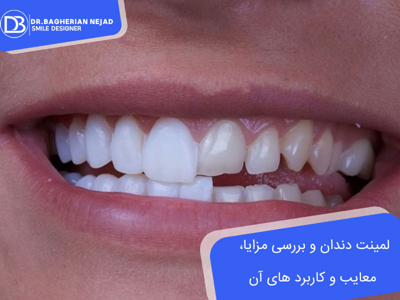 لمینت دندان و بررسی مزایا، معایب